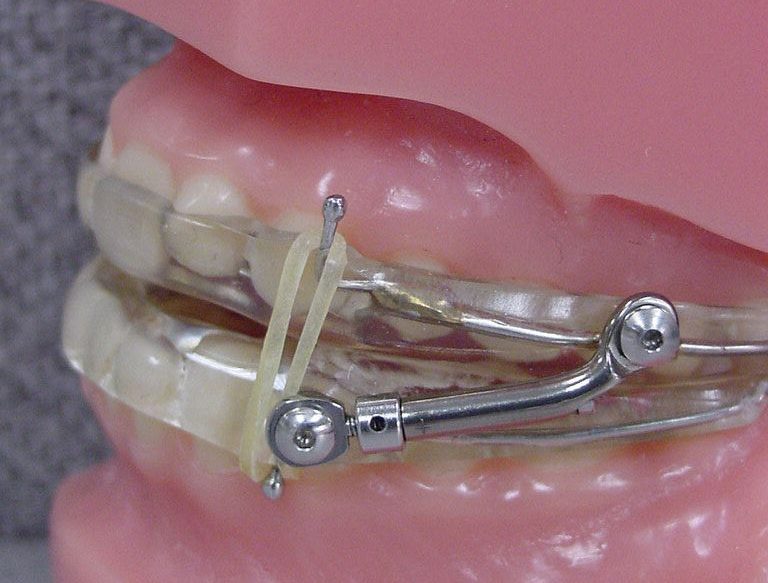 Oral Appliance Therapy Lee's Summit CPAP Alternative Dr Pribyl